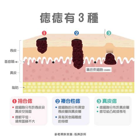 身上痣|痣變大、痣多或長毛會變皮膚癌？認識痣的形成與原因